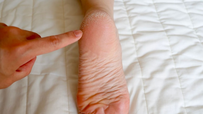 बटाटा टाचांना घासल्यास काय होईल? थंडीत रोज रात्री उपाय करून पाहा; बदल पाहून आश्चर्यचकीत व्हाल