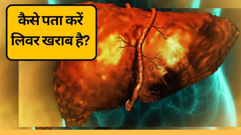 कैसे पता करें लिवर खराब है? | लिवर डैमेज के 5 बड़े संकेत, जिन्हें नजरअंदाज न करें!