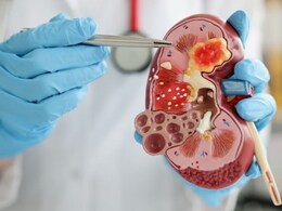 Chronic Kidney Disease Linked To Trouble With Brain Function, Study Finds