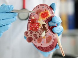 Chronic Kidney Disease Accelerates Cognitive Decline Differently In Men And Women, Study Finds
