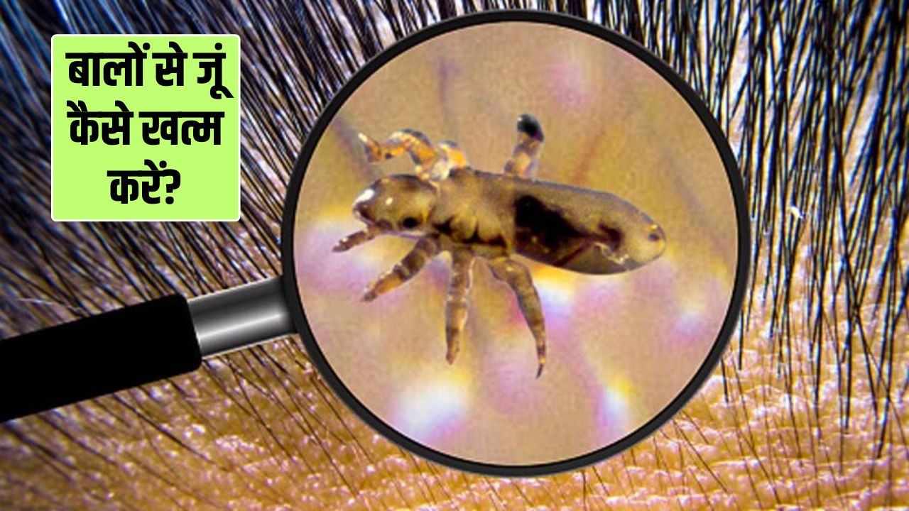 सिर में जुएं हो जाएं तो क्या करना चाहिए? डॉक्टर हंसाजी ने बताए 3 घरेलू नुस्खे, दूर हो जाएगी समस्या