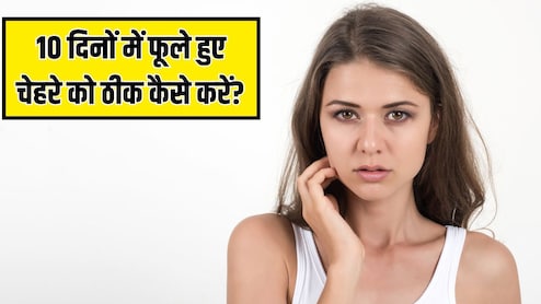 फूला-फूला दिख रहा है चेहरा? डर्मेटोलॉजिस्ट ने बताया चेहरे की सूजन को 10 दिनों में कम कैसे करें