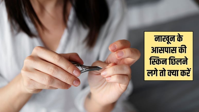 नाखूनों के आसपास वाली त्वचा छिलने लगे तो क्या करें? ये रही आसान टिप्स, मुलायम हो जाएगी स्किन