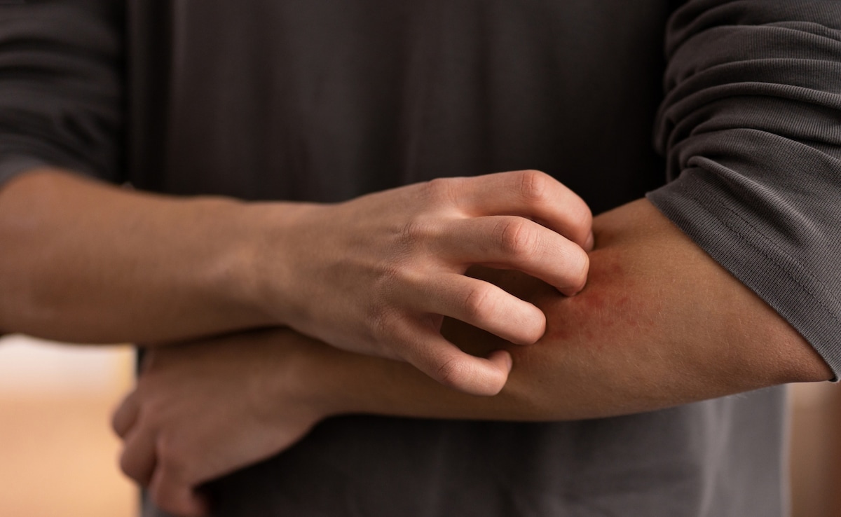 Mosquito Myths That Need To Buzz Off: What Really Spreads Dengue And Malaria