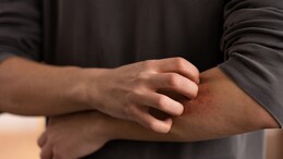 Mosquito Myths That Need To Buzz Off: What Really Spreads Dengue And Malaria