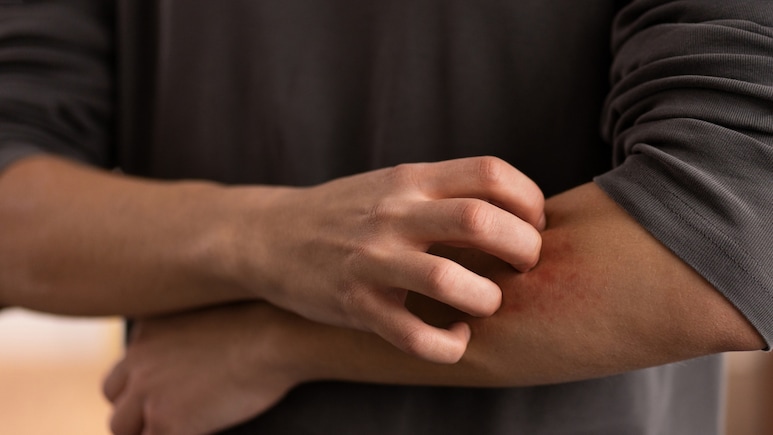 Mosquito Myths That Need To Buzz Off: What Really Spreads Dengue And Malaria