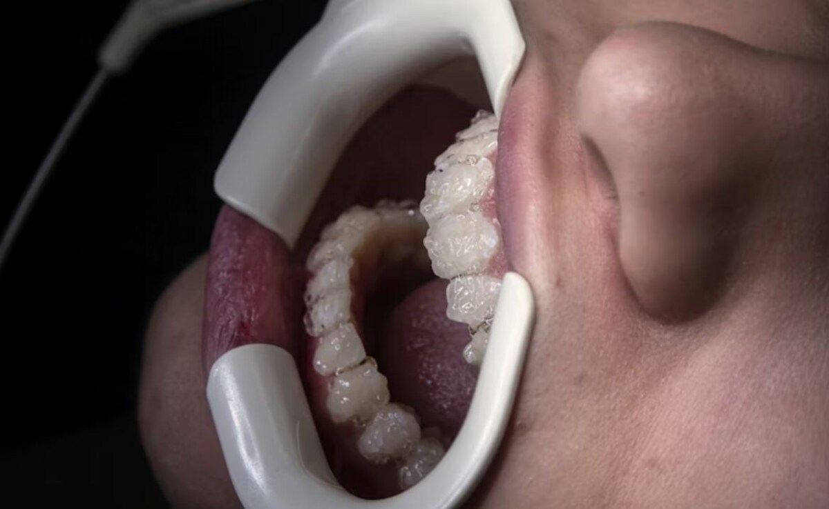 Oral Bacterium Linked to MS Disability