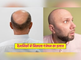 वैज्ञानिकों ने ढूंढ निकाला पुरुषों में गंजेपन का इलाज, अब गंजे सिर पर भी उगेंगे बाल