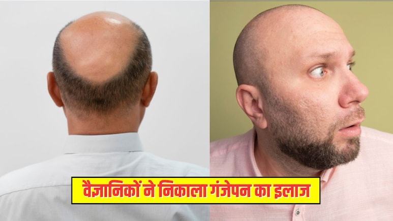 वैज्ञानिकों ने ढूंढ निकाला पुरुषों में गंजेपन का इलाज, अब गंजे सिर पर भी उगेंगे बाल