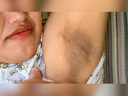 अंडरआर्म्स पर पड़े डार्क पैच कैसे साफ करें? डर्मेटोलॉजिस्ट ने बताया क्या करने से क्लीन और स्मूद हो जाएंगी आपकी Underarms
