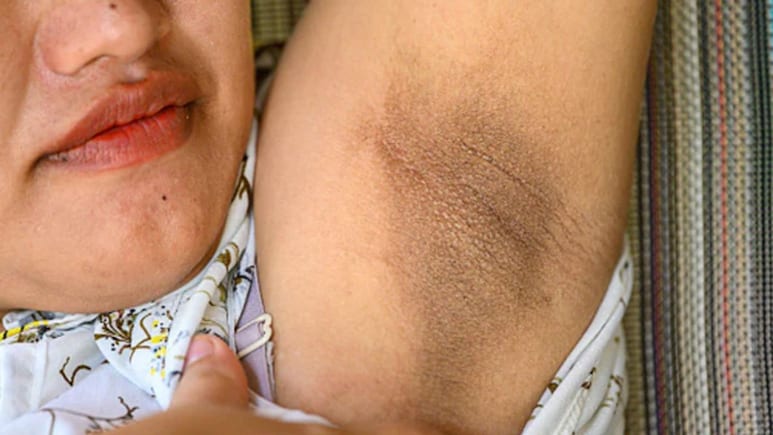 अंडरआर्म्स पर पड़े डार्क पैच कैसे साफ करें? डर्मेटोलॉजिस्ट ने बताया क्या करने से क्लीन और स्मूद हो जाएंगी आपकी Underarms