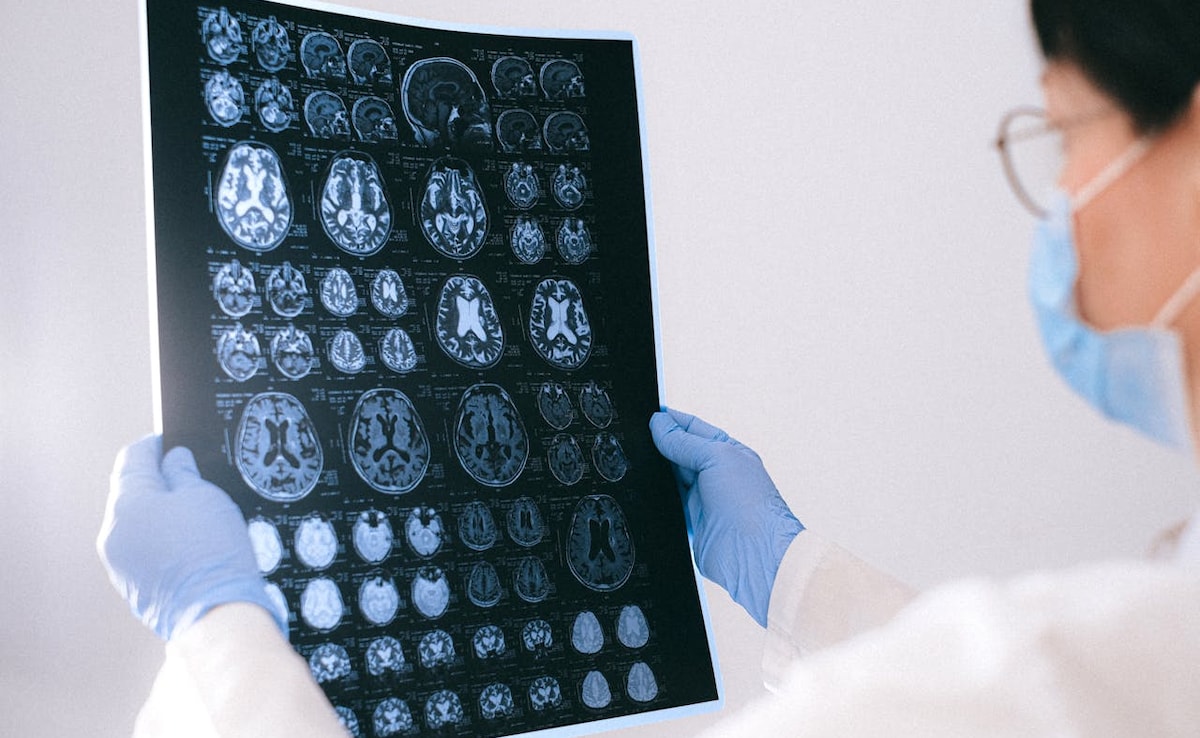 Alzheimer's Disease Can Be Reversed, Show Animal Studies