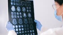 Is Poor Sleep Putting Your Brain At Risk of Alzheimer's? Doctor Answers