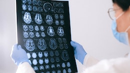 Is Poor Sleep Putting Your Brain At Risk of Alzheimer's? Doctor Answers