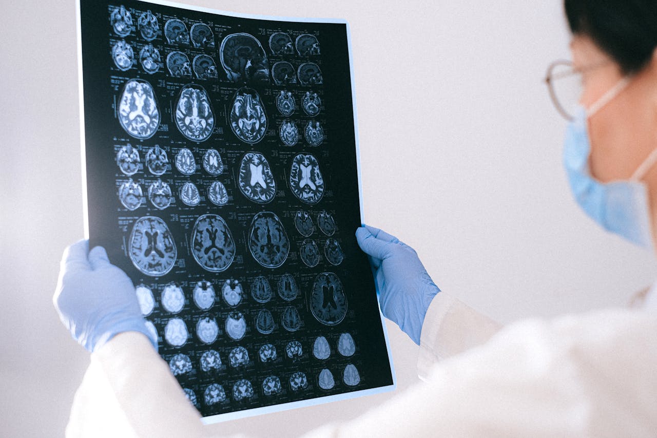 Alzheimer's Immune Response Higher In Females' Brain Than In Males, Finds New Study