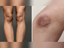 कोहनी और घुटनों का कालापन दूर करने के लिए कौनसा सीरम लगाना चाहिए? स्किन की डॉक्टर से जान लें