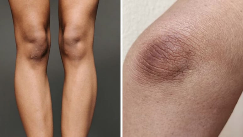 कोहनी और घुटनों का कालापन दूर करने के लिए कौनसा सीरम लगाना चाहिए? स्किन की डॉक्टर से जान लें