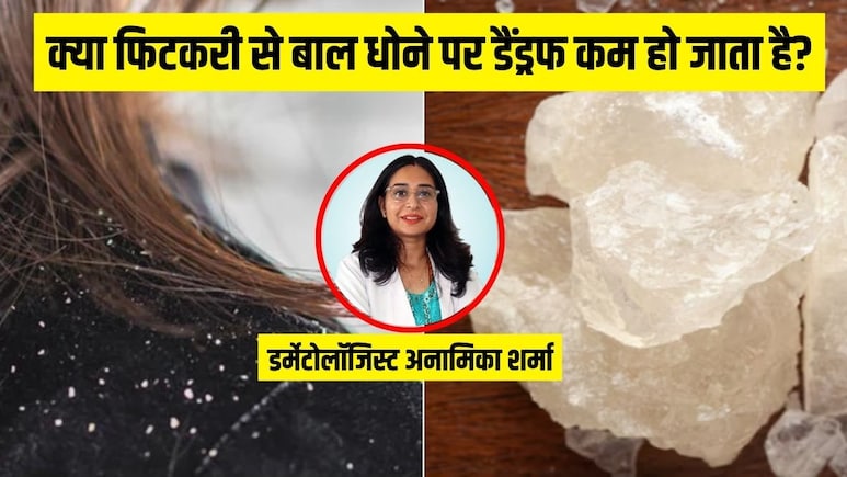 क्या फिटकरी के पानी से बाल धोने पर डैंड्रफ कम हो जाता है? डर्मेटोलॉजिस्ट से जानें जवाब