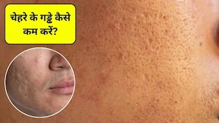 Open Pores Home Remedies: चेहरे पर गड्ढे कैसे खत्म करें? चेहरे के गड्ढे भरने के लिए 5 आसान तरीके