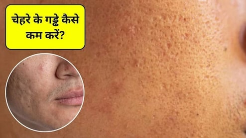 Open Pores Home Remedies: चेहरे पर गड्ढे कैसे खत्म करें? चेहरे के गड्ढे भरने के लिए 5 आसान तरीके