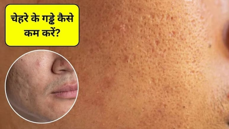 Open Pores Home Remedies: चेहरे पर गड्ढे कैसे खत्म करें? चेहरे के गड्ढे भरने के लिए 5 आसान तरीके