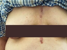 सत्तरी ओलांडलेल्या पुरुषाचे महिलेसारखे दिसू लागले स्तन, डॉक्टरही चक्रावले