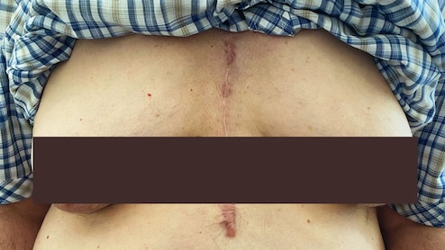 सत्तरी ओलांडलेल्या पुरुषाचे महिलेसारखे दिसू लागले स्तन, डॉक्टरही चक्रावले