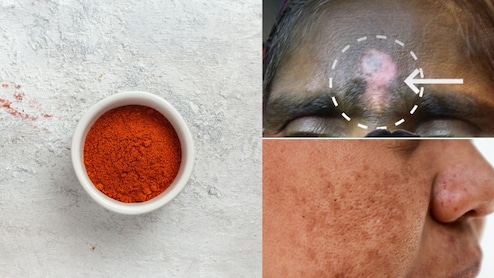 क्या सिंदूर लगाने से भी झाइयां बढ़ती हैं? स्किन की डॉक्टर से जानें माथे और मांग में सिंदूर लगाने से क्या होता है