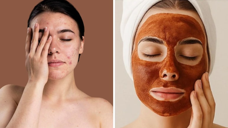 चेहरे पर ऐसा क्या लगाएं जिससे चेहरा साफ हो जाए? आयुर्वेदिक डॉक्टर ने बताया इस पाउडर से गायब हो जाएंगे पिंपल के निशान