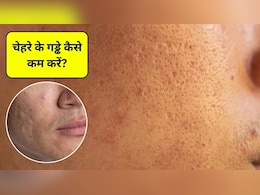 चेहरे पर गड्ढे कैसे खत्म करें? चेहरे के गड्ढे भरने के लिए क्या खाएं, जानिए यहां