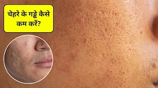 चेहरे पर गड्ढे कैसे खत्म करें? चेहरे के गड्ढे भरने के लिए क्या खाएं, जानिए यहां