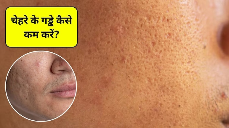 चेहरे पर गड्ढे कैसे खत्म करें? चेहरे के गड्ढे भरने के लिए क्या खाएं, जानिए यहां