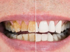 दांत से मिलता है अमीरी-गरीबी का संकेत, रिपोर्ट में हुआ खुलासा