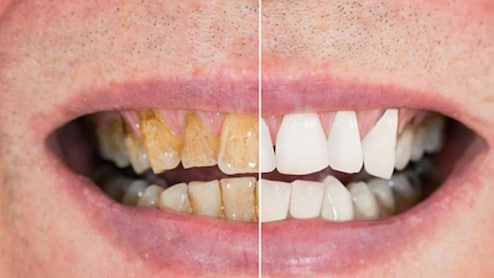 दांत से मिलता है अमीरी-गरीबी का संकेत, रिपोर्ट में हुआ खुलासा