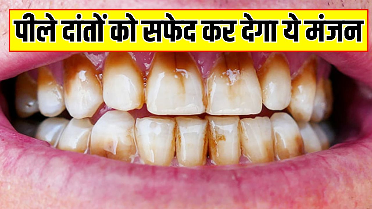 पीले दांतों को सफेद बना देगा ये दंत मंजन, आयुर्वेदिक डॉक्टर सलीम जैदी ने बताया बस 10 मिनट में बनाने का तरीका