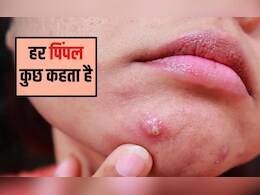 चेहरे पर पिंपल किसकी कमी से होता है? पिंपल को जड़ से खत्म करने के लिए क्या करना चाहिए, जान&zwj;िए यहां
