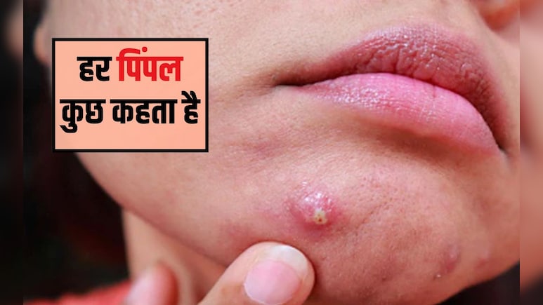 चेहरे पर पिंपल किसकी कमी से होता है? पिंपल को जड़ से खत्म करने के लिए क्या करना चाहिए, जान&zwj;िए यहां