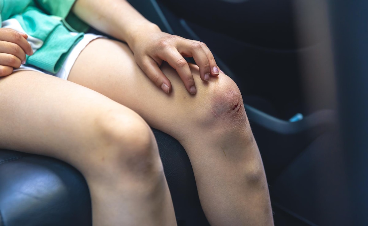 Bruises Leaving Marks? Here's When It's Normal And What To Do About It