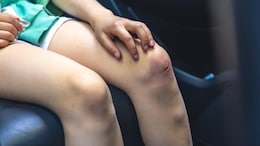 Bruises Leaving Marks? Here's When It's Normal And What To Do About It