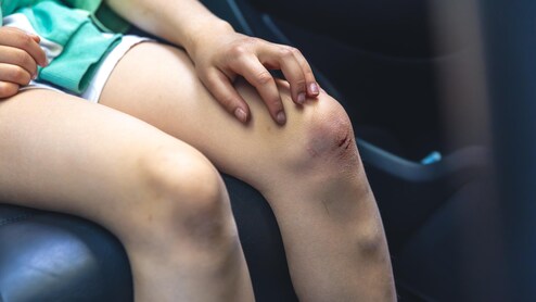 Bruises Leaving Marks? Here's When It's Normal And What To Do About It