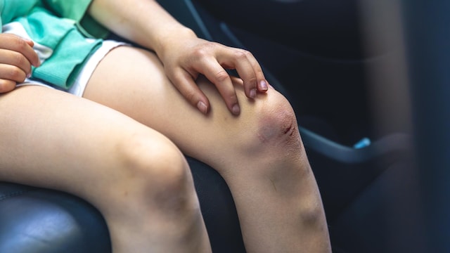 Bruises Leaving Marks? Here's When It's Normal And What To Do About It
