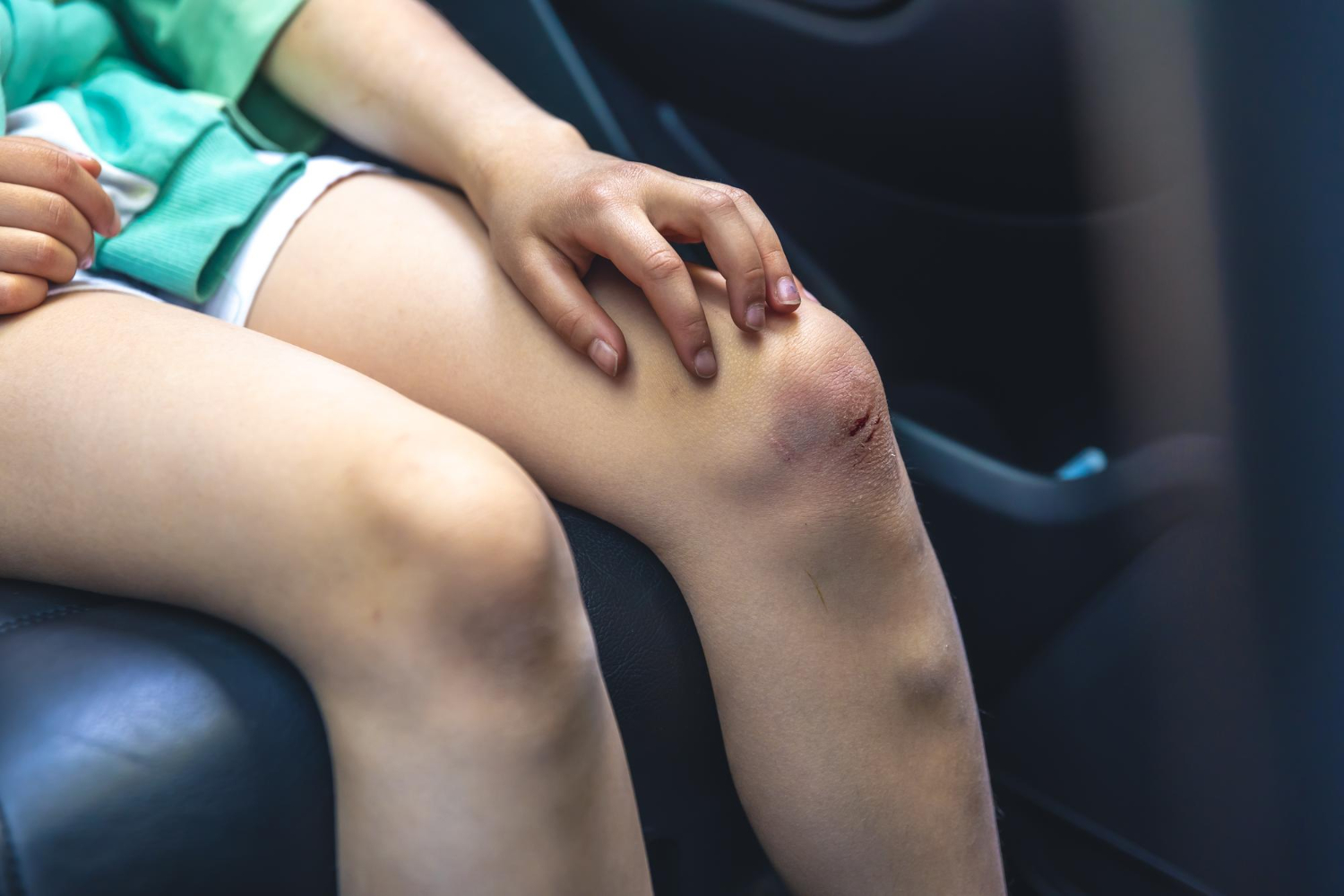 Bruises Leaving Marks? Here's When It's Normal And What To Do About It