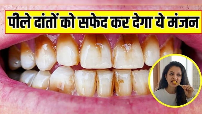 15 दिनों में सफेद हो जाएंगे पीले दांत, हेल्थ कोच ने बताया बस घर पर बनाकर लगा लें ये सस्ता पाउडर