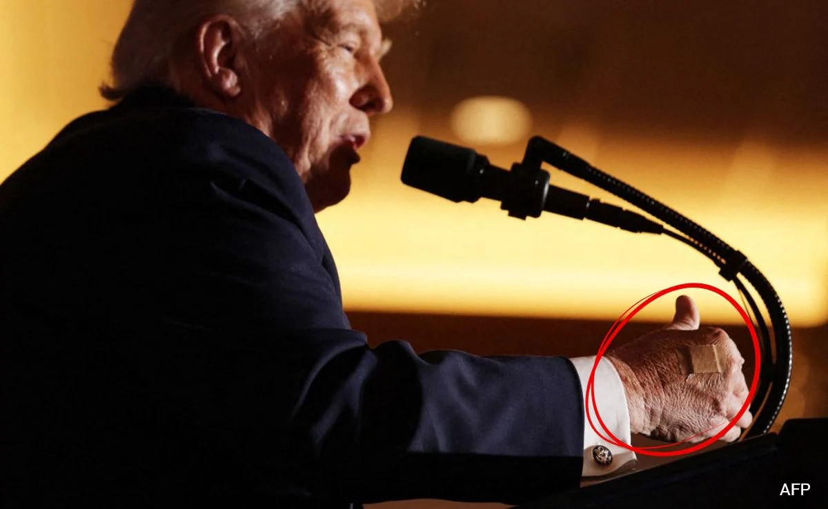 "He Is Constantly Shaking Hands": White House On Trump's Bandaged Hand