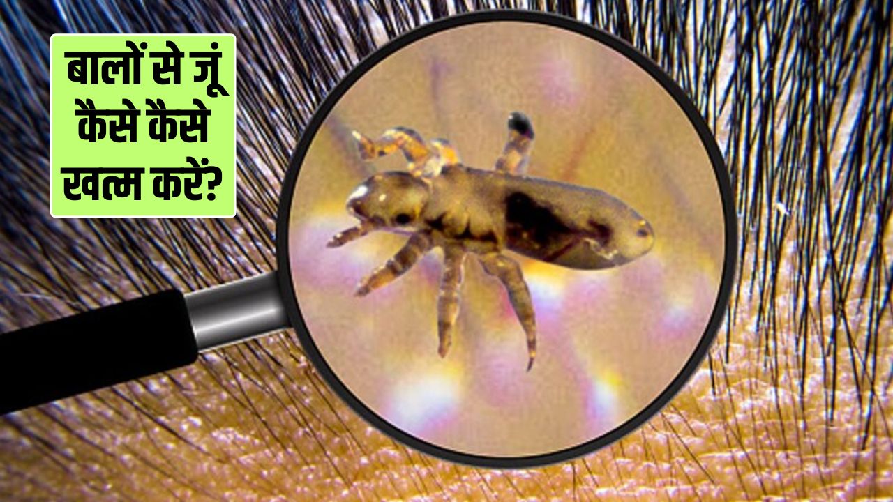 सिर में जुएं हो जाएं तो क्या करना चाहिए? डॉक्टर हंसाजी ने बताए 3 घरेलू नुस्खे, दूर हो जाएगी समस्या