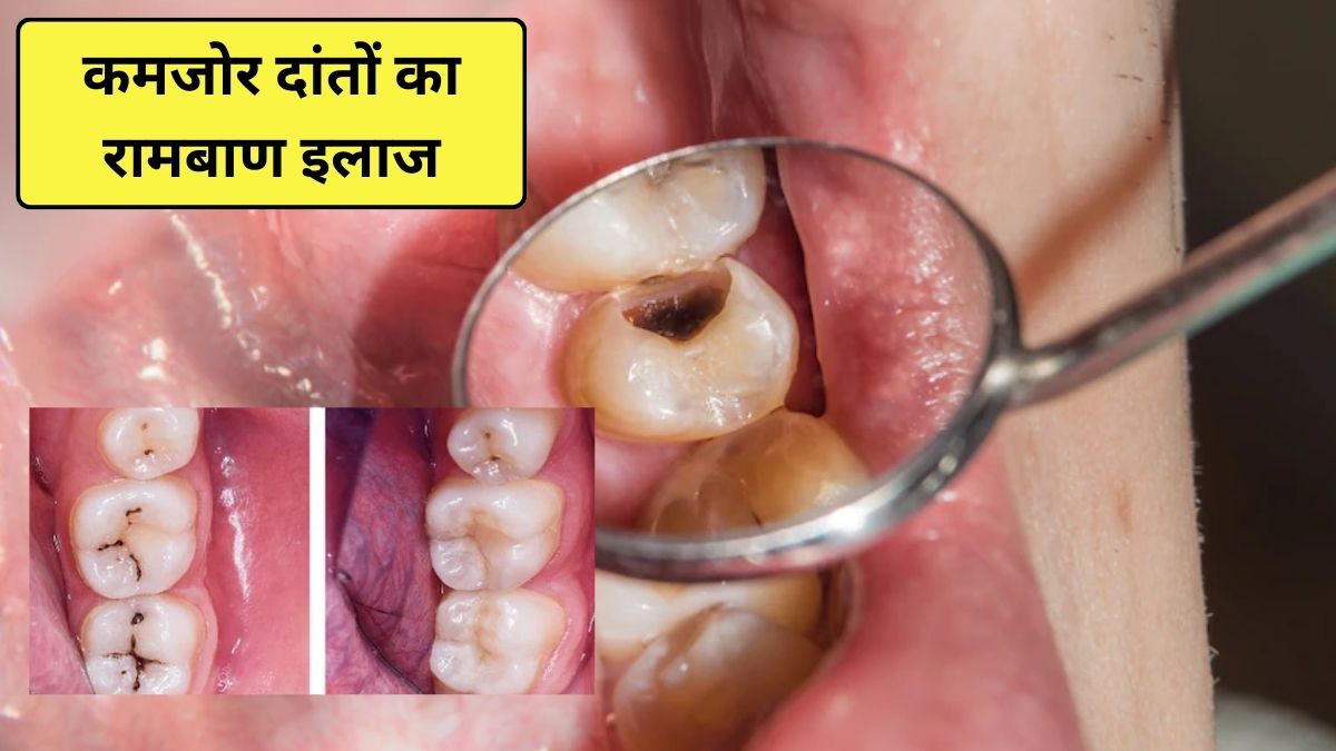 दांत खोखले और कमजोर हो रहे हैं? इन 3 तरीकों से मिलेगी राहत, मर जाएंगे दांतों के सारे कीटाणु और मसूड़े भी होंगे मजबूत
