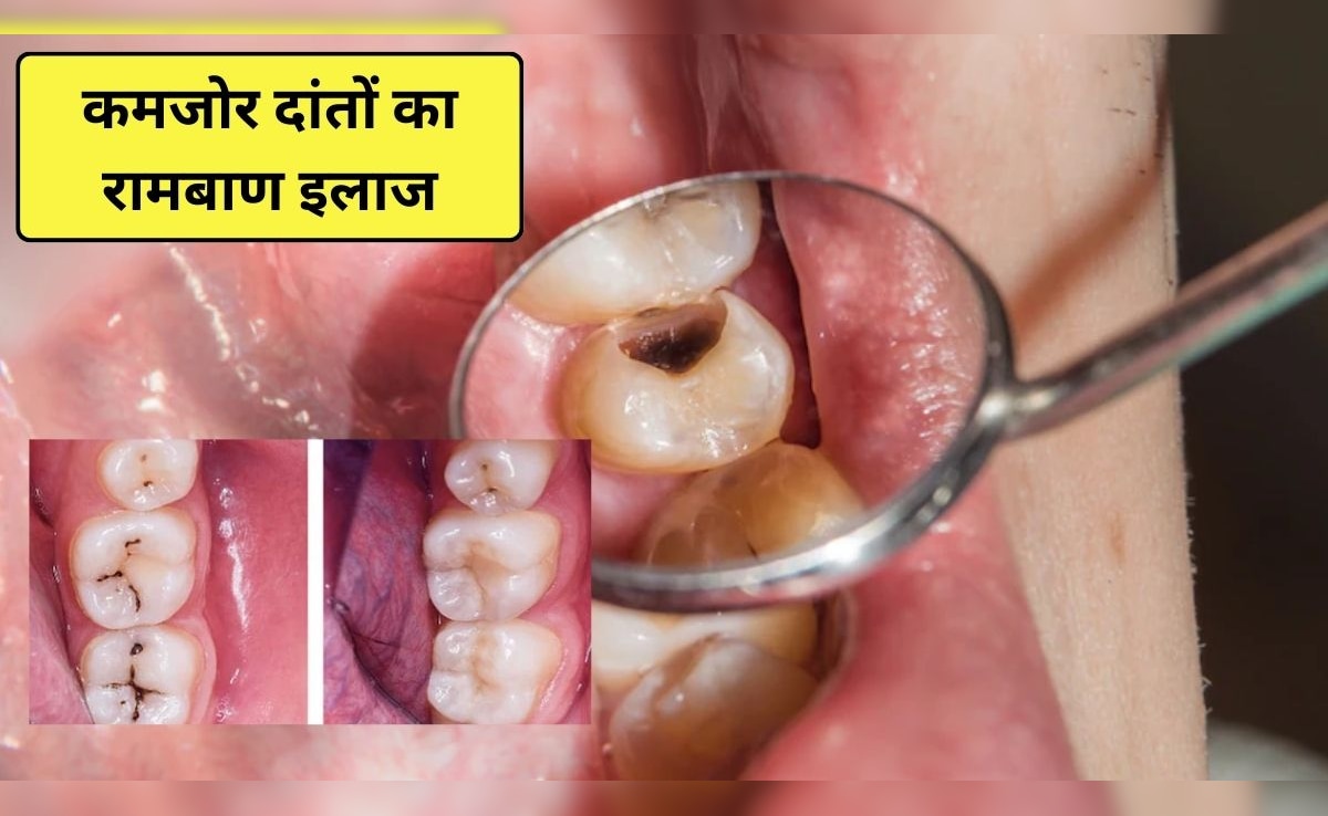 दांत खोखले और कमजोर हो रहे हैं? इन 3 तरीकों से मिलेगी राहत, मर जाएंगे दांतों के कीटाणु और मसूड़े होंगे मजबूत