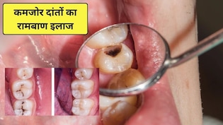दांत खोखले और कमजोर हो रहे हैं? इन 3 तरीकों से मिलेगी राहत, मर जाएंगे दांतों के सारे कीटाणु और मसूड़े भी होंगे मजबूत