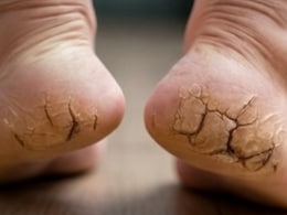 Cracked Heels Treatment: सर्दी में फटी एड़ियों से हो जाते हैं परेशान, तो इस आयुर्वेदिक उपाय से पा सकते हैं छुटकारा