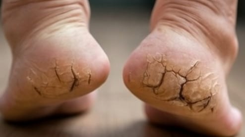 Cracked Heels Treatment: सर्दी में फटी एड़ियों से हो जाते हैं परेशान, तो इस आयुर्वेदिक उपाय से पा सकते हैं छुटकारा
